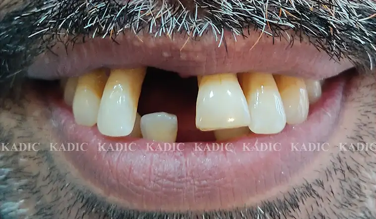 Before Image