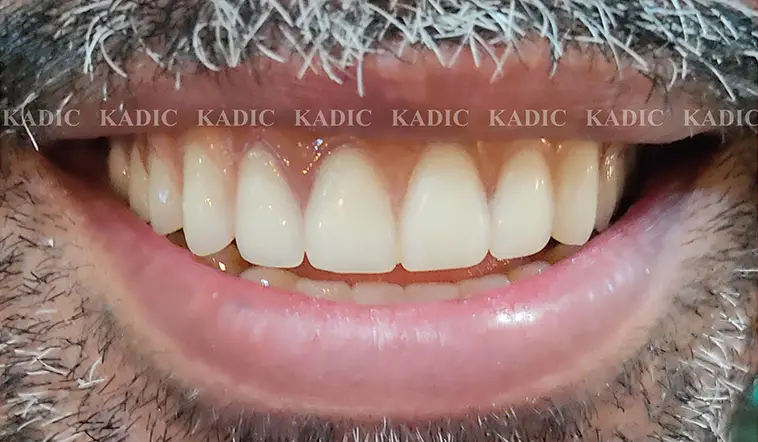 After Image