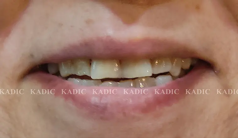 Before Image