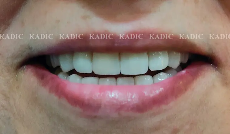 After Image